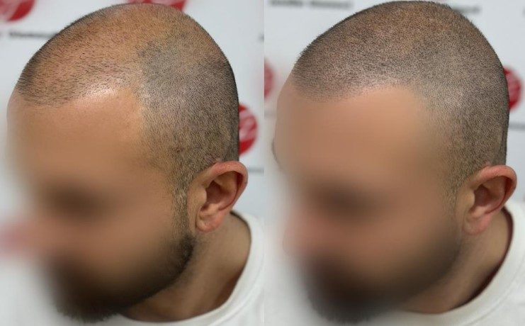 tricopigmentation tatouage calvitie