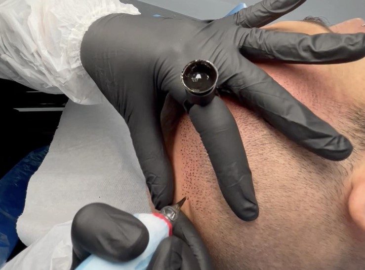 traitement-calvitie-tricopigmentation